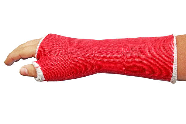 Cast Orthopedic cast as treatment for scaphoid fracture orthopedic cast stock pictures, royalty-free photos & images