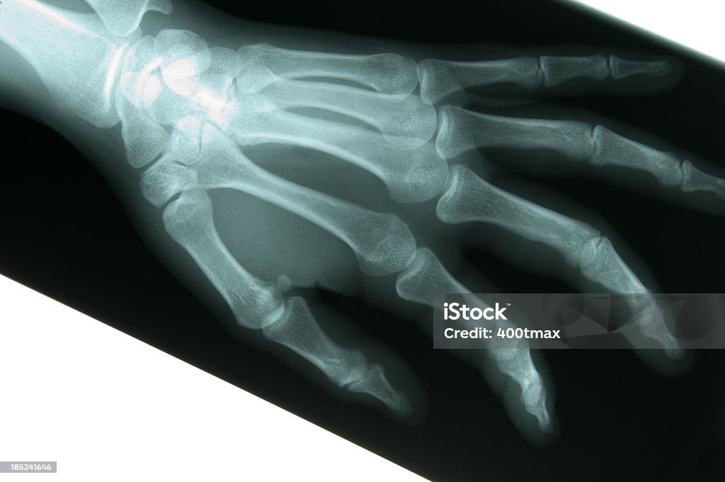 X-ray d'une femme s Main - Photo de Anatomie libre de droits