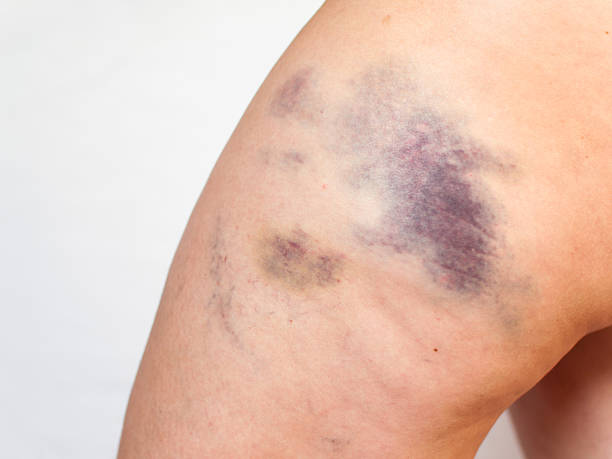 Bruise Bruise on leg - one day after accident bruise stock pictures, royalty-free photos & images