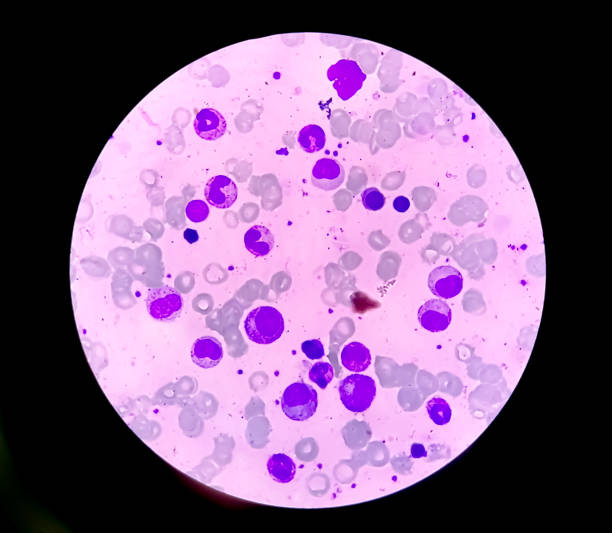 istock Bone marrow study: Suggestive of reactive marrow with dimorphic Erythroid hyperplasia 1852538946