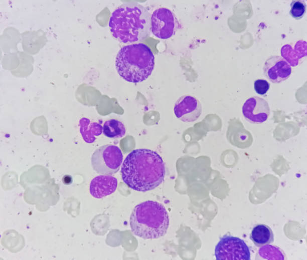 istock Bone marrow study: Suggestive of reactive marrow with dimorphic Erythroid hyperplasia 1852539462