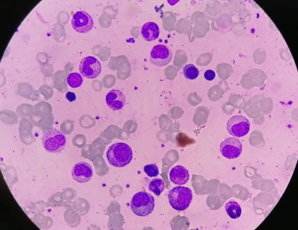 istock Bone marrow study: Suggestive of reactive marrow with dimorphic Erythroid hyperplasia 1852540170