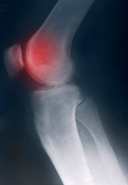 istock Pain in a knee. Arthritis 185256502