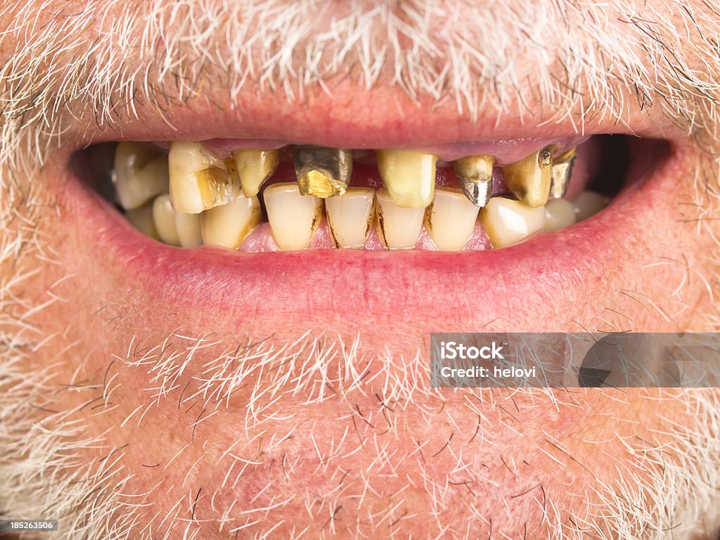 Bad teeth Mouth of a senior man with bad teeth. short grey beard. Rudeness Stock Photo