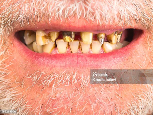 Bad Teeth Stock Photo - Download Image Now - Rudeness, Scurvy, Senior Men