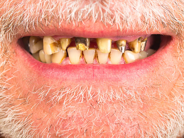 bad zębów - cynga zdjęcia i obrazy z banku zdjęć