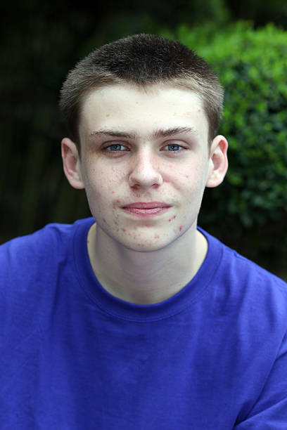 istock Teenage acne 185271175
