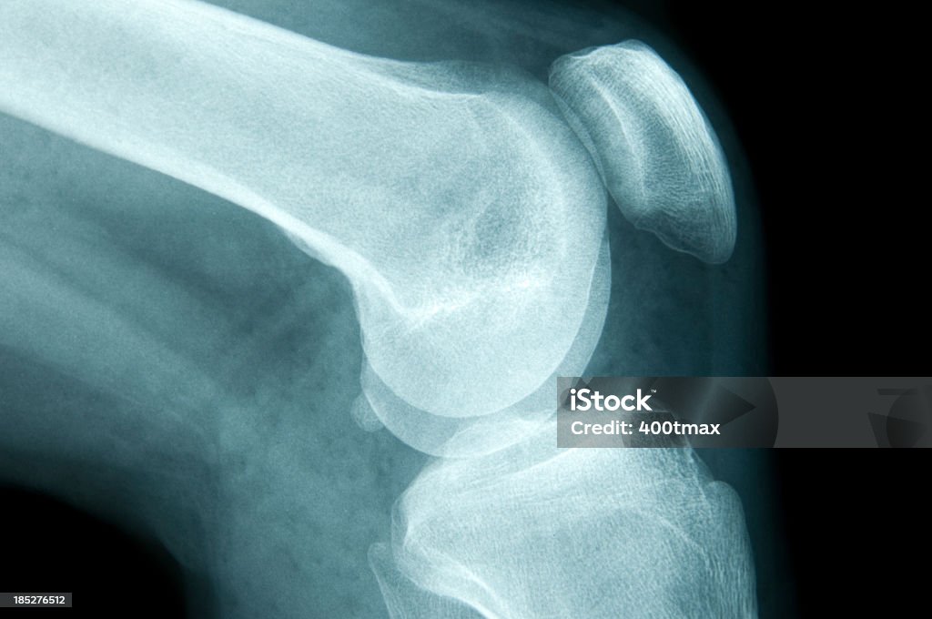 Xray の人間の男性の膝 - 骨粗鬆症のロイヤリティフリーストックフォト
