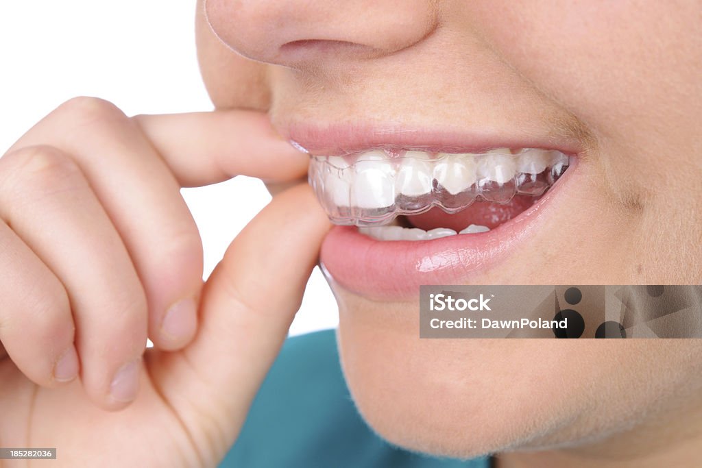 Retainer Person putting in a retainer.PLEASE CLICK ON THE IMAGE BELOW TO SEE MY MEDICAL TECHNOLOGY LIGHTBOX: Dental Aligner Stock Photo