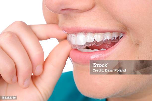 Retainer Stock Photo - Download Image Now - Dental Aligner, Adjusting, Close-up