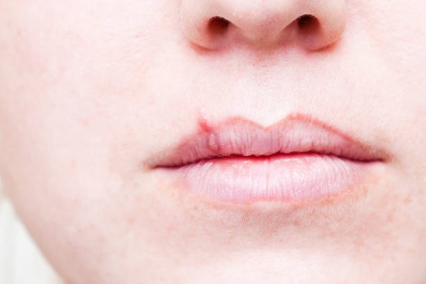 Herpes Fieberbläschen in Mouth – Foto