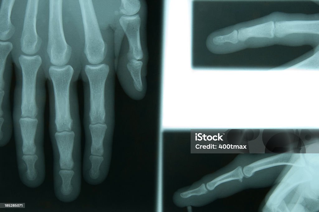 X-ray of женщина's hand - Стоковые фото Анатомия роялти-фри