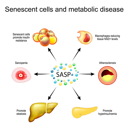 Senescent cells and metabolic disease. Senescence-associated secretory phenotype SASP. Senescent cells promote insulin resistance, liver steatosis, muscle atrophy and Sarcopenia, hyperinsulinemia in pancreas, and atherosclerosis. Aging process and Chronic Inflammation. Vector diagram