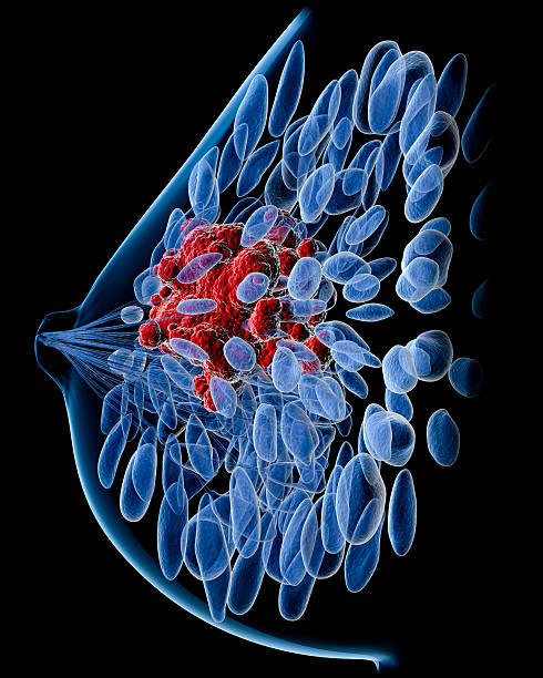 vista laterale del carcinoma mammario - mammogram mri scan breast breast examination foto e immagini stock