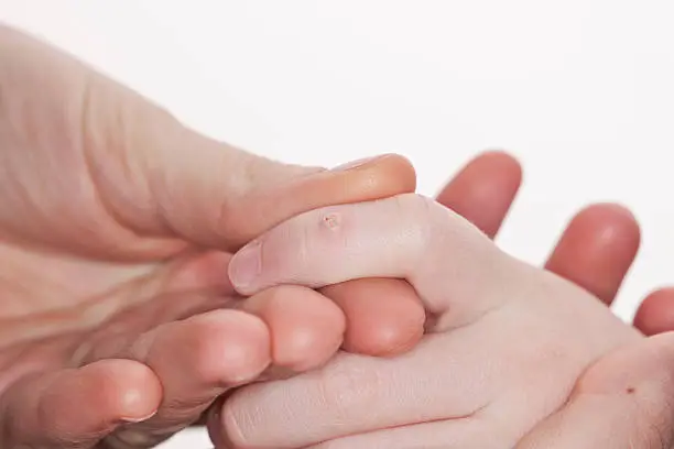 Photo of An adult holds the hand of a child with a macro wart