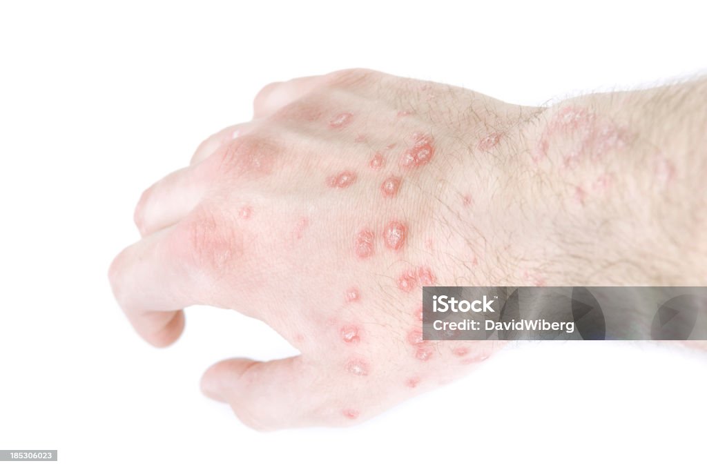 手肌、乾癬 rashes - 乾癬のロイヤリティフリーストックフォト