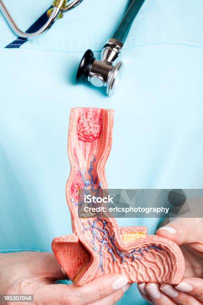 Nurse With Esophagus Model Stock Photo - Download Image Now - Esophagus, Abdomen, Cancer - Illness