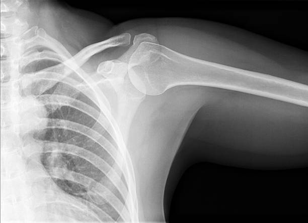 X-ray picture - Shoulder joint stock photo