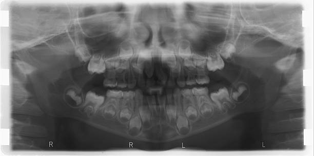 X-ray teeth. stock photo