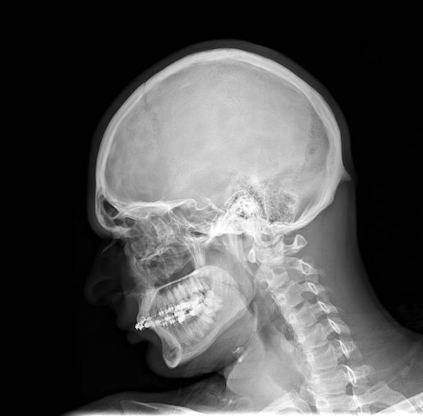 X-ray picture - Skull and cervical spine stock photo