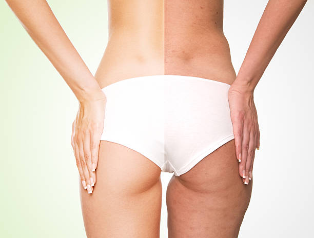 antes e depois. - women human leg body buttocks imagens e fotografias de stock