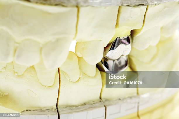 プラスター色のメタリックキャストの歯のインプラント - クローズアップのストックフォトや画像を多数ご用意 - クローズアップ, テクノロジー, ヒトのアゴの骨