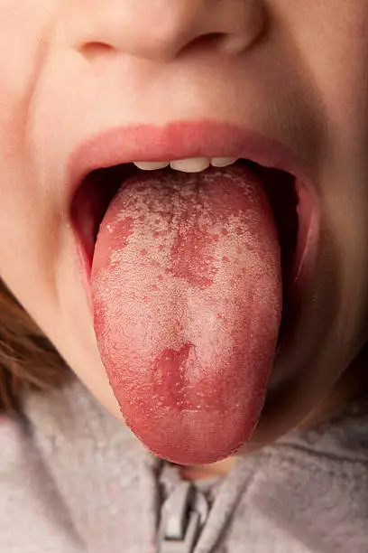 A little girl with a serious sore throat shows her geographic tongue.