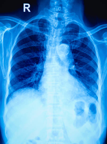 istock X-ray of human chest image. 1854549355