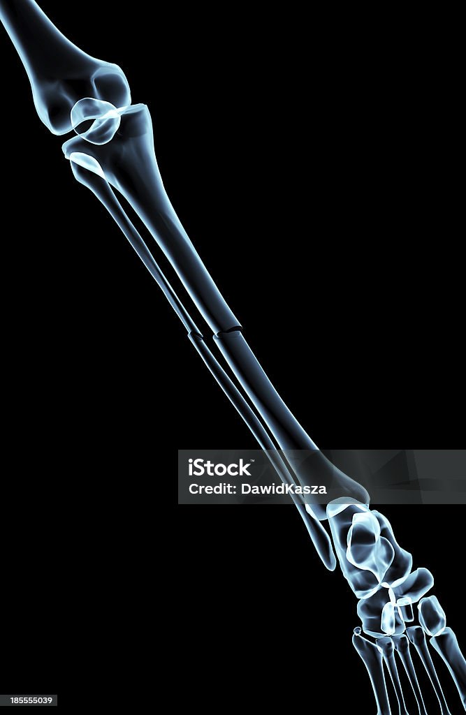 브로컨 뼈다귀 아래에 x-레이 - 로열티 프리 3차원 형태 스톡 사진