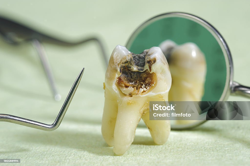 extracted tooth extracted tooth with dental caries Alloy Stock Photo
