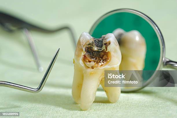 Extracted Tooth Stock Photo - Download Image Now - Alloy, Care, Cut Out