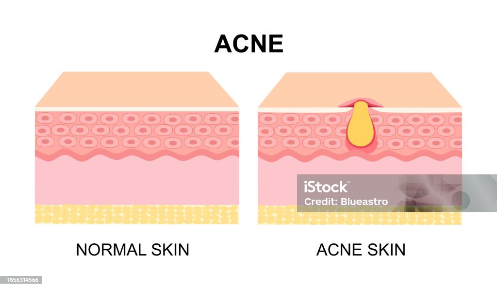 Normal Acne Amount Difference Of Normal Skin Layer And Skin Layer With Acne Illustration ...