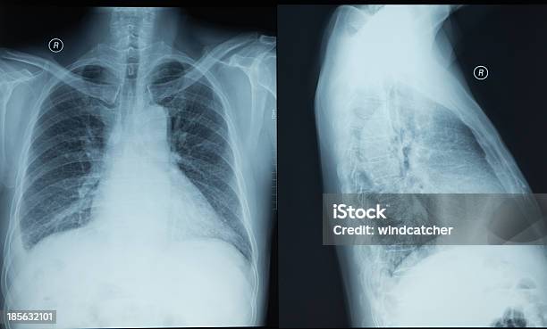 Photo libre de droit de Xray Du Thorax Humain banque d'images et plus d'images libres de droit de Imagerie par rayons x - Imagerie par rayons x, Corps humain, Personnes féminines