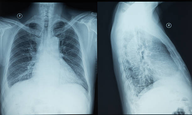 istock x-ray of a human thorax 185632101