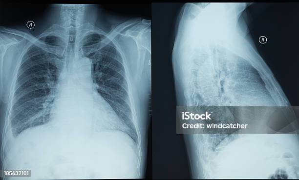 Raio X Do Tórax Humano - Fotografias de stock e mais imagens de Imagem de raios X - Imagem de raios X, Corpo humano, Sexo Feminino