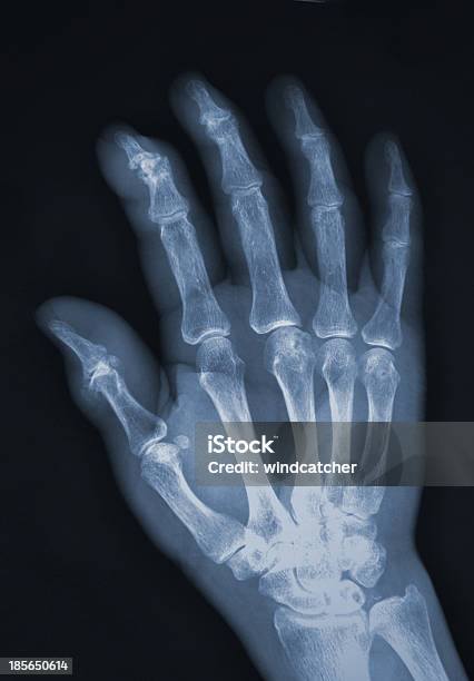 Photo libre de droit de Xray Main Humaine banque d'images et plus d'images libres de droit de Anatomie - Anatomie, Articulation du corps humain, Articulations