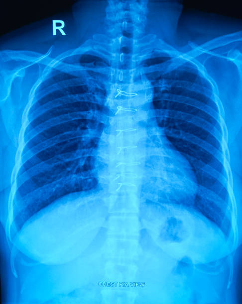 istock X-ray of human chest image. 1856689215