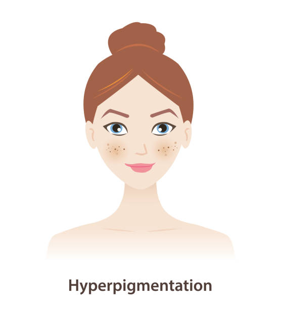 Hyperpigmentation Face Sticker 280+ Hyperpigmentation Face Stock Illustrations, Royalty-Free Vector ...