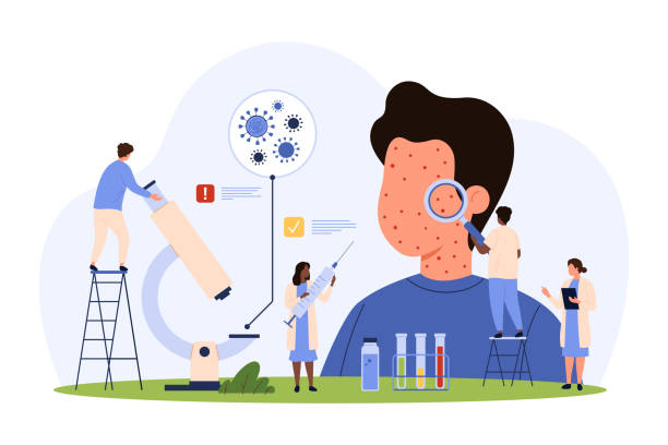 Diagnosis of infectious contagious disease, tiny people check symptoms of measles Diagnosis of infectious contagious disease, measles. Tiny people with magnifying glass check symptoms of measles, red rash and itchy skin face in sick child patient cartoon vector illustration measles stock illustrations