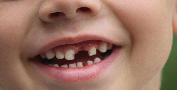 istock The child lost a tooth. Selective focus.Concept baby tooth 1857835285