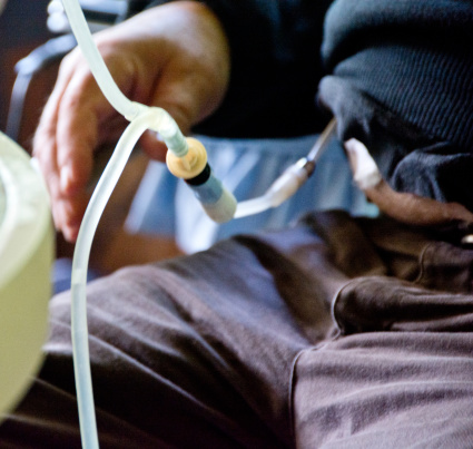 Peritoneal dialysis tubing is attached to the abdominal connection of a male patient.