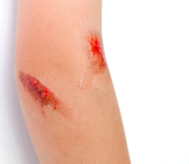 Close-up of bloody scrapes on child's arm stock photo