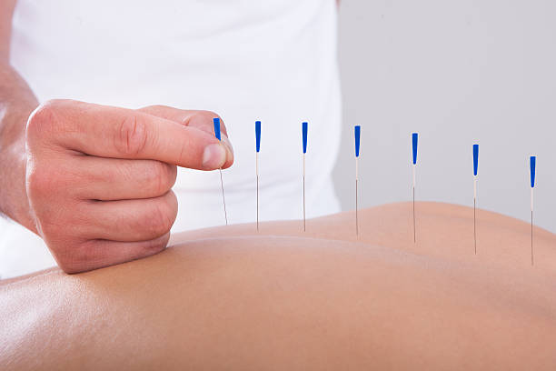 istock Woman Receiving An Acupuncture Therapy 185966952