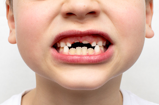Losing primary teeth or milk teeth change. Close-up of fallen baby teeth on the upper jaw. Swelling of the gums. Shot of a face isolated on a gray background. Oral care concept