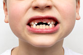 Losing primary teeth or milk teeth change