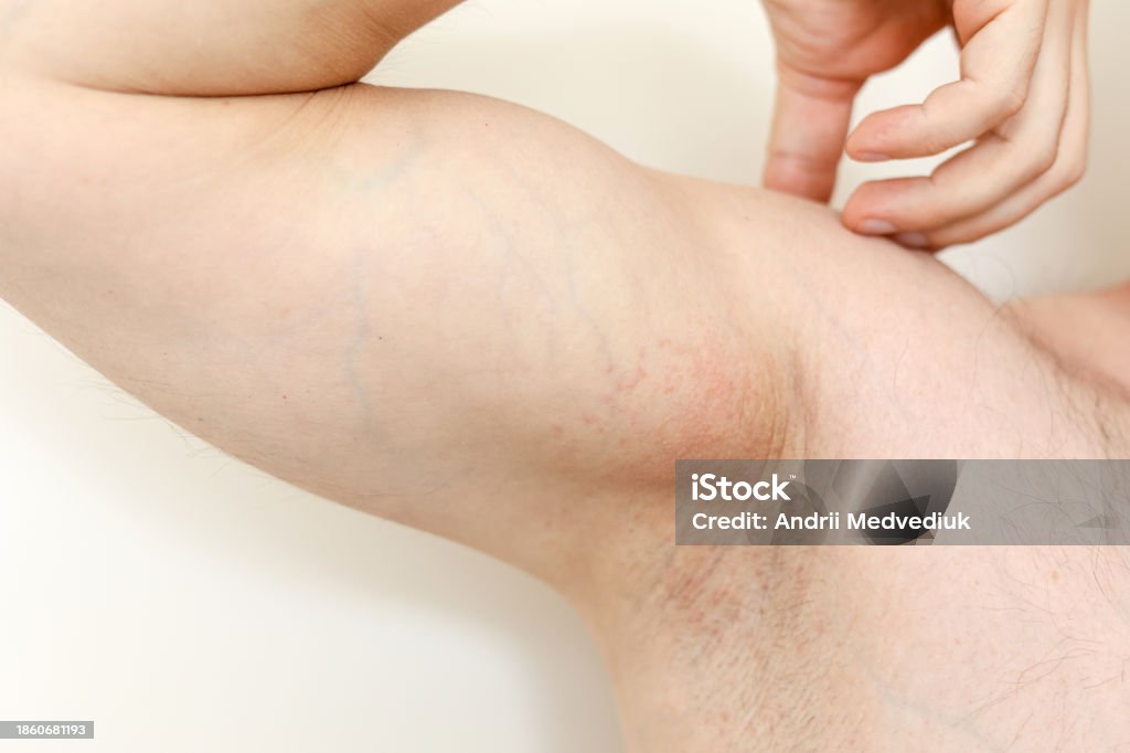 Deodrant Rash Armpit Rash Unrecognisable Man Shows Irritation On The Sensitive Skin ...