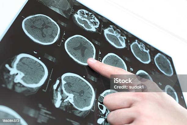 Exame De Tac Ao Doente - Fotografias de stock e mais imagens de Doença de Parkinson - Doença de Parkinson, Exame Médico com Imagem de Diagnóstico, Doença de Alzheimer