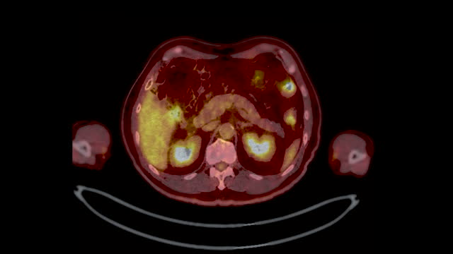 A PET-CT scan .