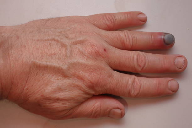 istock Pinch point finger injury 1862092333