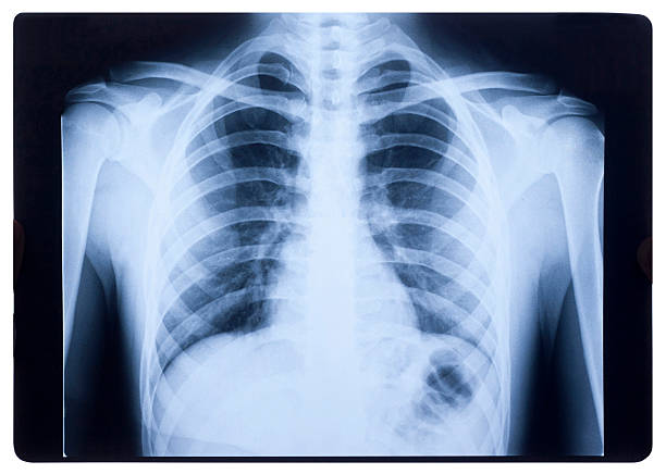 x-ray, der brust - libs stock-fotos und bilder